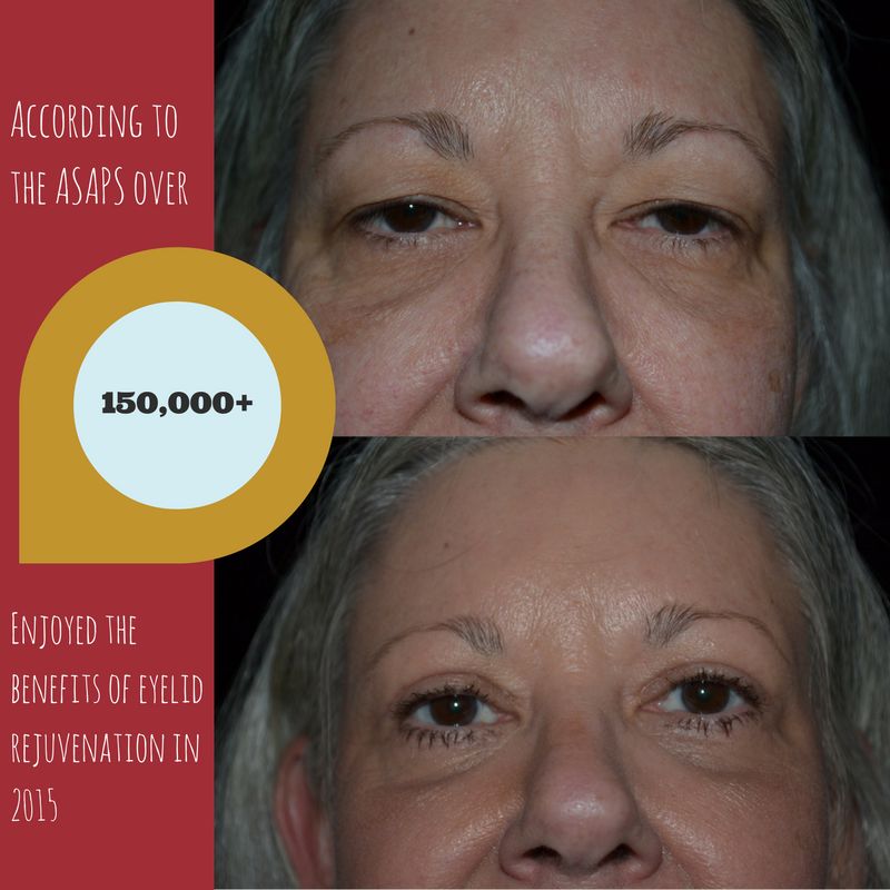 Is Eyelid Rejuvenation Right for You? 1 Eyelid Rejuvenation