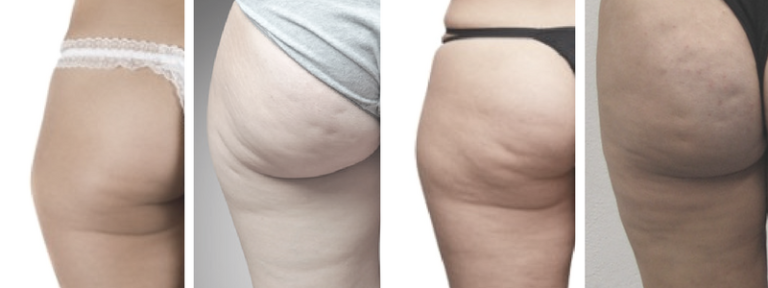 10 FACTS ABOUT CELLULITE, STRETCH MARKS & FAT 3 cellulite