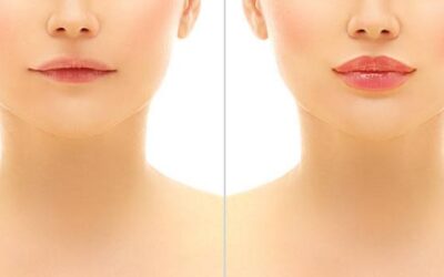 Lip Injections Can Create A More Youthful And Natural Lip Line