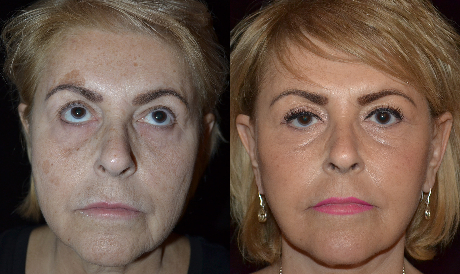 Dysport® 1 Before ActiveFX Treatment