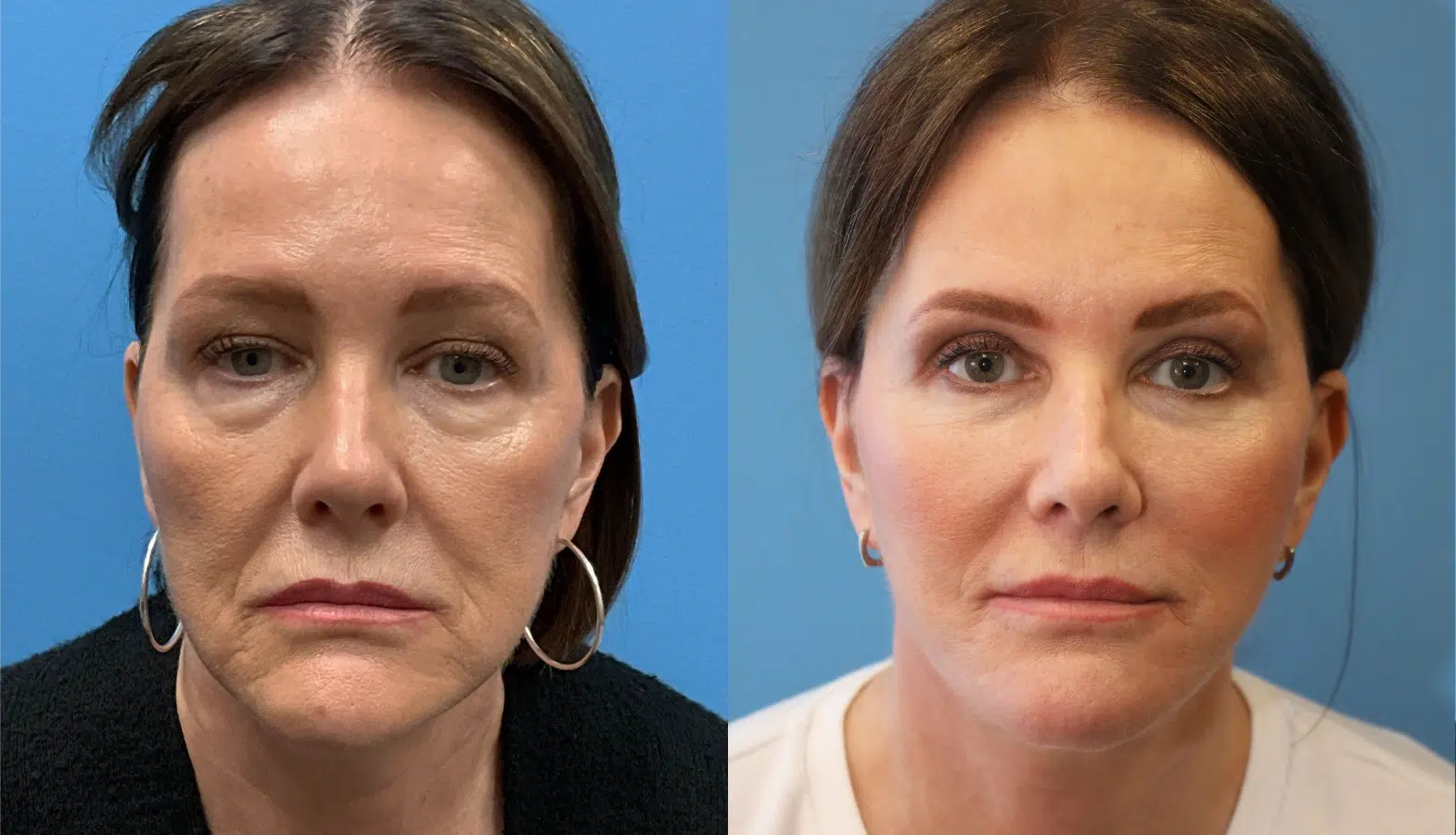 befoe and after facial procedure